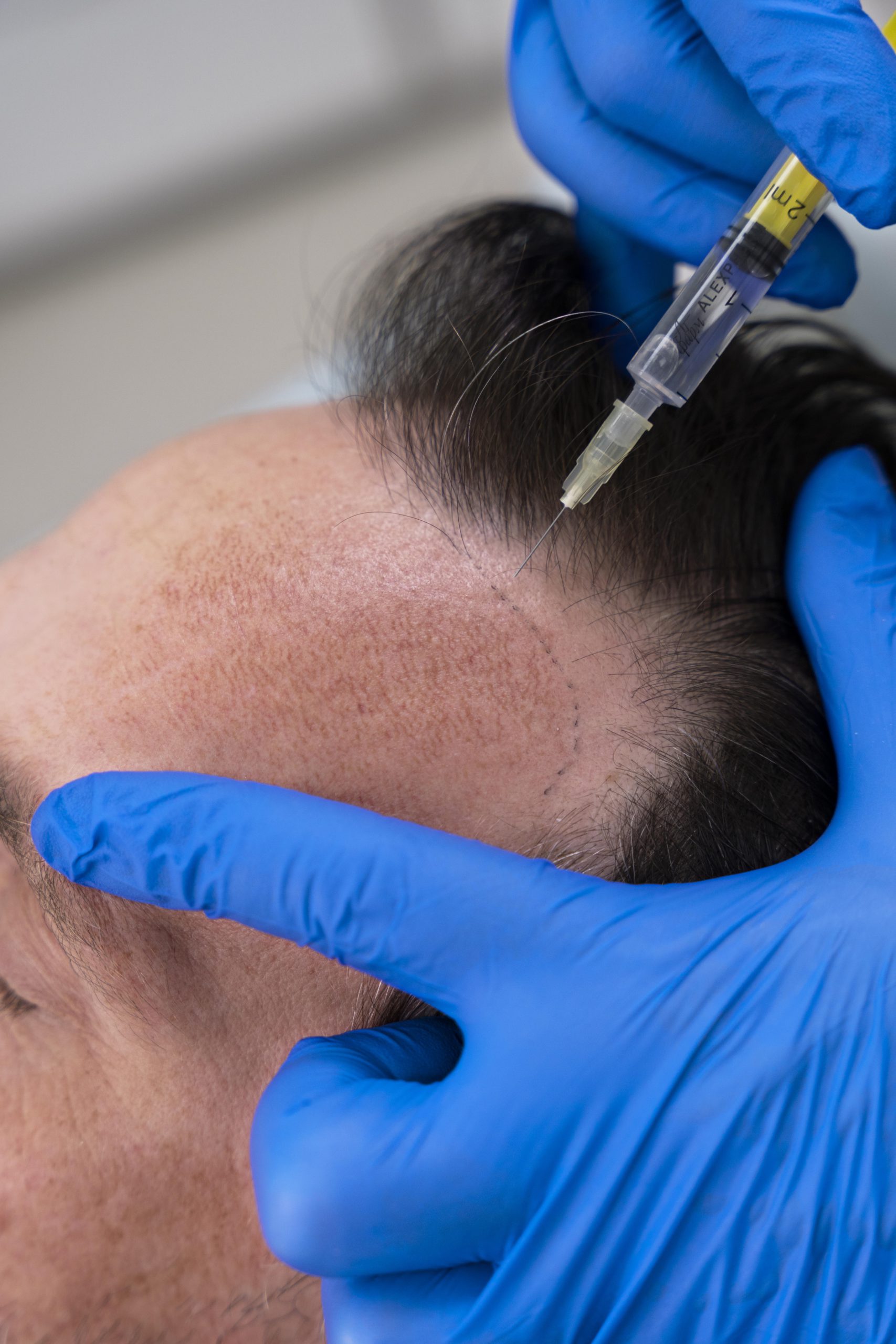 Hair Transplant Nuderm Aesthetics