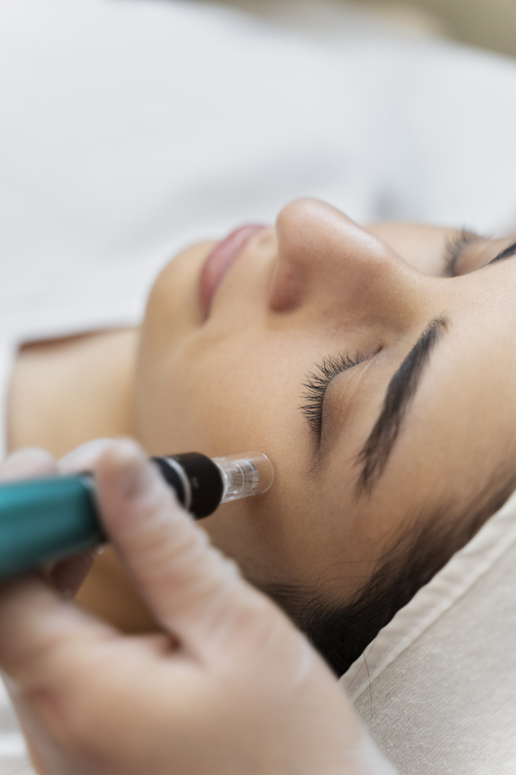 Micro Needling Nuderm Aesthetics